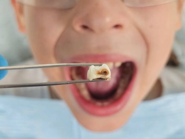 Best Emergency Wisdom Teeth Removal in Montgomery, TX