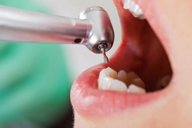 Best Emergency Root Canal Treatment in Montgomery, TX